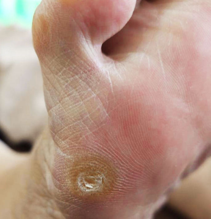 角質ケア施術前